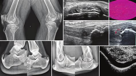 Lateral X-rays of knee (a) ankle (b) and elbow (c) showing enthesophyte... | Download Scientific ...