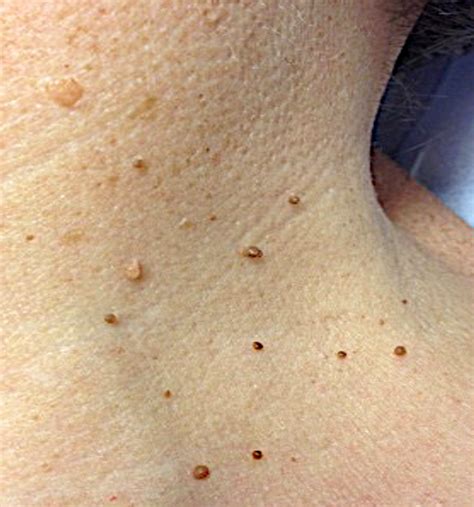 The difference between skin tags and warts - Sterex