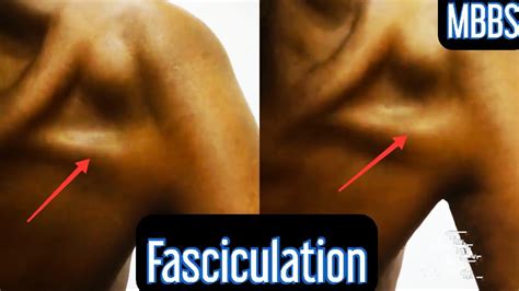 What is Muscle Fasciculation? - YouTube