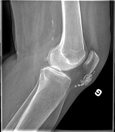 Calcific bursitis - superficial infrapatellar | Radiology Case | Radiopaedia.org