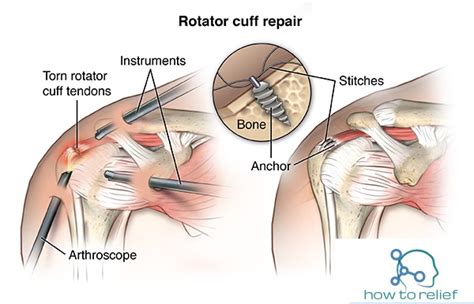 Rotator Cuff Tear! Symptoms, Causes, Diagnosis, Treatment & Exercises ...