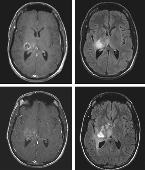 Cat Scan Brain Tumor