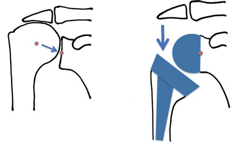 Reverse shoulder arthroplasty | Bone & Joint