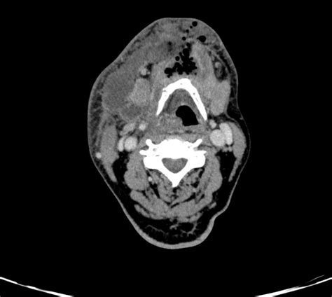 Ludwigs Angina Radiology