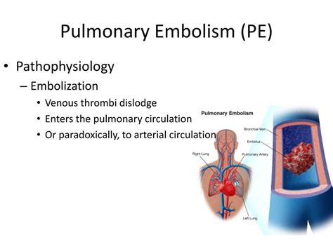 Pulmonary Embolism