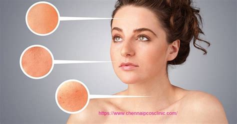 PCOS and Acne - PCOS Treatment in Chennai | PCOS hospital Chennai