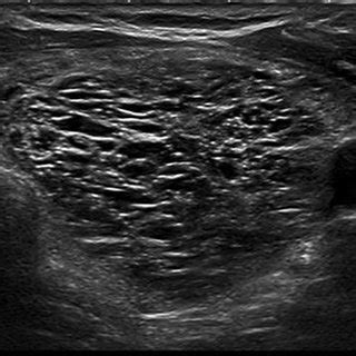 EU-TIRADS 2: spongiform nodule. Transverse plane. | Download Scientific Diagram