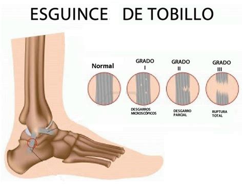 Cuatro consejos para curar bien un esguince de tobillo | FisioOnline