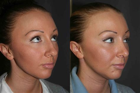 Rhinoplasty Surgery Information