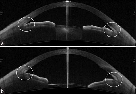 A Anterior segment OCT of an angle closure glaucoma with narrow angles ...