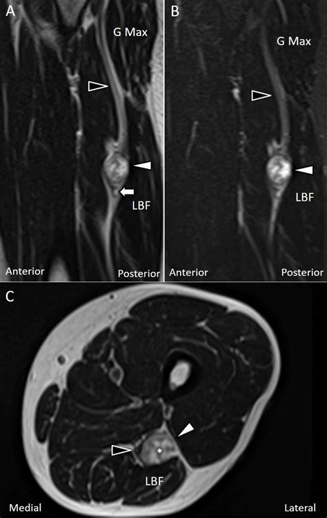 Cureus | Ultrasound Imaging for a Rare Cause of Sciatica: A Schwannoma of the Sciatic Nerve