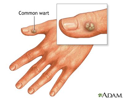 Warts: MedlinePlus Medical Encyclopedia