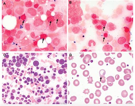 Ringed Sideroblasts Vs Basophilic Stippling