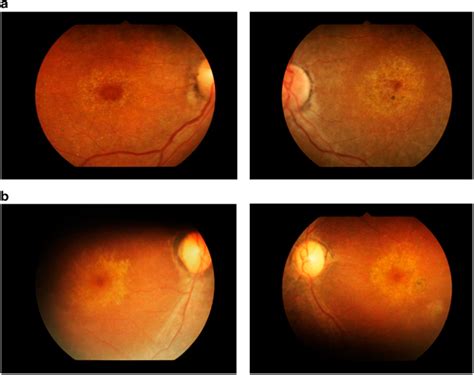 What Is Bull's Eye Maculopathy and How to Manage It | OBN