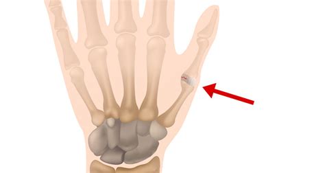 Breaking your thumb ligament - familyloxa