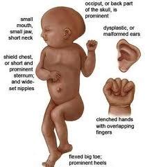 Trisomy 18 (Edward Syndrome) Chromosomal & Genetic Defect | Dr.Thind