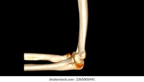 2,151 Elbow Pain Scan Images, Stock Photos, 3D objects, & Vectors | Shutterstock