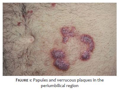 Surgical & Cosmetic Dermatology | Successful treatment of chromoblastomycosis using cryosurgery ...