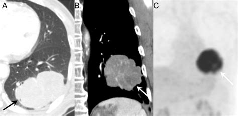 Peripheral-located large cell neuroendocrine carcinoma of the lung in a ...