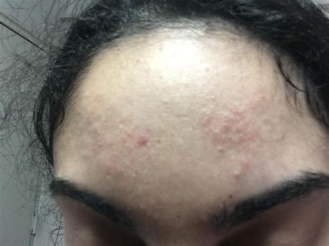 Forehead rash or acne? - General acne discussion - Acne.org