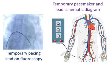 What is temporary pacing? – All About Heart And Blood Vessels