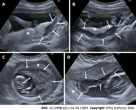 Antenatal imaging: A pictorial review