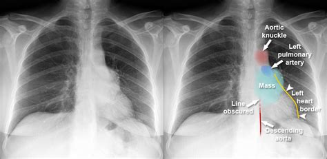 Chest X-ray - Mediastinum and hilum - Posterior mediastinal mass