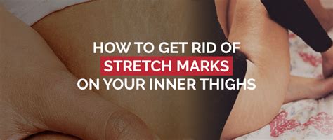 4 Ways to Get Rid of Stretch Marks on Your Inner Thigh Fast