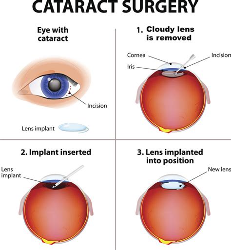 Eye Surgery for Cataracts, Pterygiums, Eyelid Lesions and Ptosis - ACE