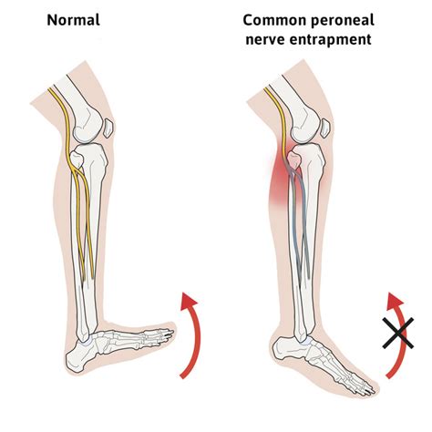 Know All About Drop Foot Treatment, its Causes and Symptoms