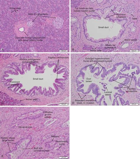 Carcinoma of the Pancreas - Clinical Tree