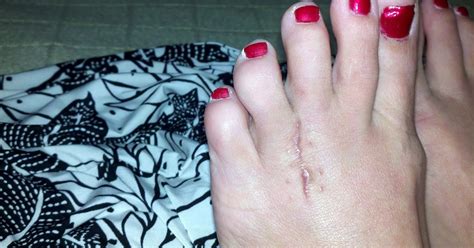 Morton's Neuroma Surgery Recovery: Ten Weeks Post-Op