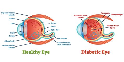 Diabetic retinopathy | AOA