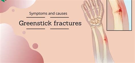 Symptoms of Greenstick Fracture - MEDizzy