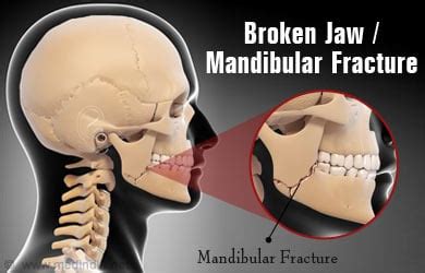 Broken Jaw | Mandibular Fracture - Types, Causes, Symptoms, First Aid, Treatment