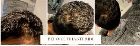 Finasteride: Before and After Images