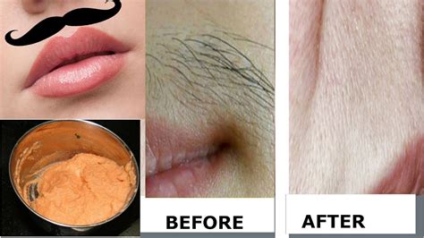 DIY: Remove unwanted hairs naturally at home/ 100% result/ permanent hair removal - YouTube