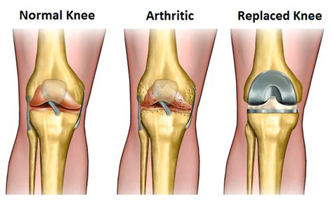 Common questions about knee replacement surgery: Orthopedic Center for ...