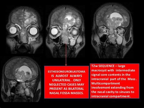 Olfactory neuroblastoma