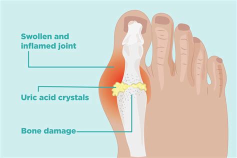 Opioids Are Often Prescribed for Gout Attacks: Study