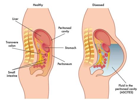 Ascites