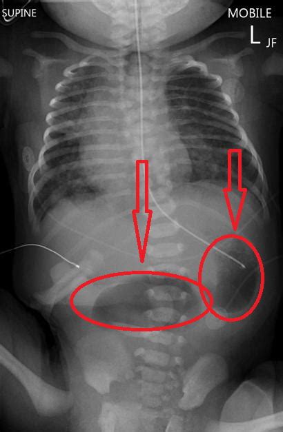 Duodenal atresia x ray - wikidoc