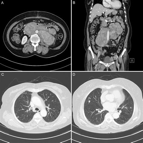 Retroperitoneal smooth muscle tumor of uncertain malignant potential ...