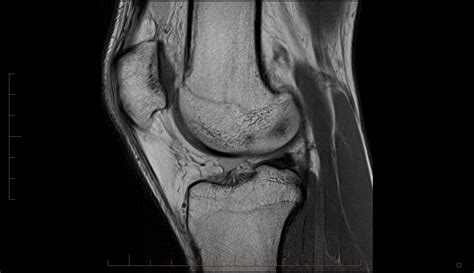 Radiology Cases: Prefemoral Fat Pad Contusion from Direct Injury