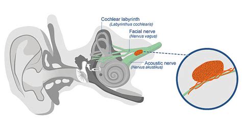 Acoustic neuroma - Causes, symptoms & treatment | hear.com