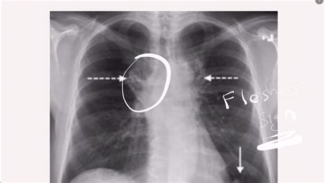 HD - Chest X-ray in Pulmonary Embolism | EM:RAP