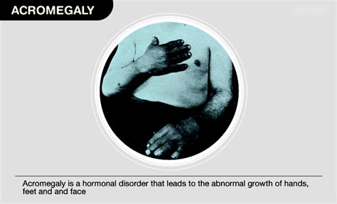 Understanding Acromegaly: Causes, Symptoms, Diagnosis, Treatment, and Complications