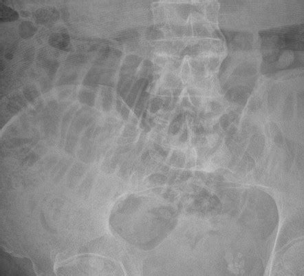 Valvulae conniventes | Radiology Reference Article | Radiopaedia.org