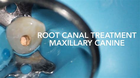 Root Canal Treatment on Maxillary Canine (Tooth 23) - YouTube