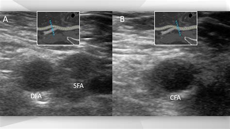 Ultrasound-guided puncture of the femoral artery for TAVI